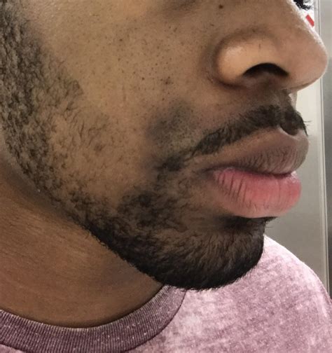 black spots after shaving face